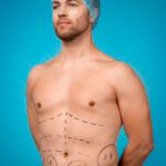 Gynecomastia
