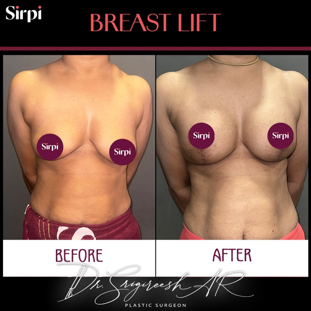 Breast Surgery before and after