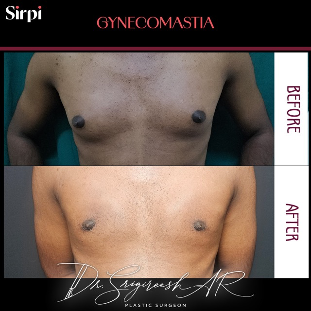 Gynecomastia before and after