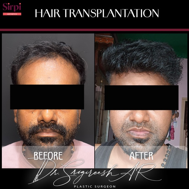 Hair Transplant before and after