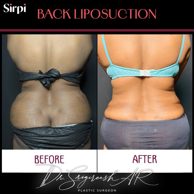 Liposuction before and after
