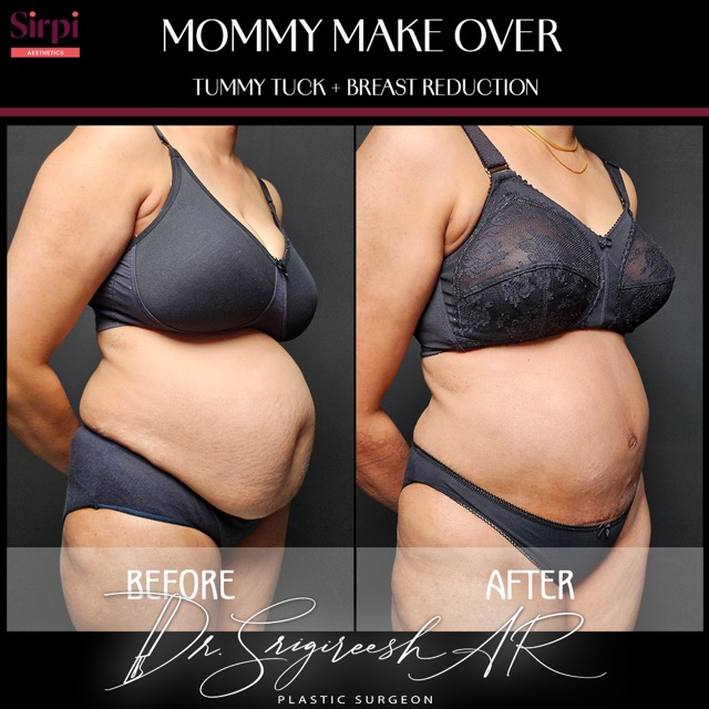 Mommy Makeover before and after