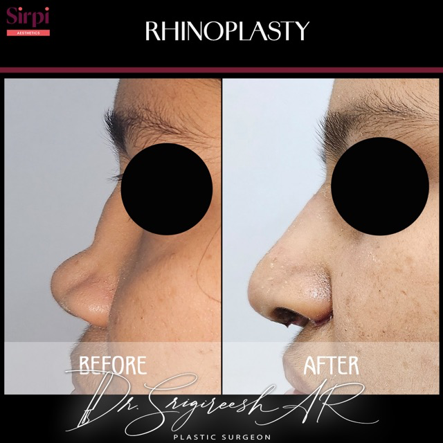 Rhinoplasty before and after