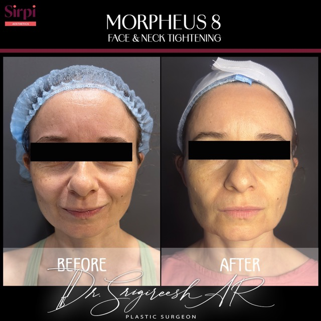 Skin Treatment before and after
