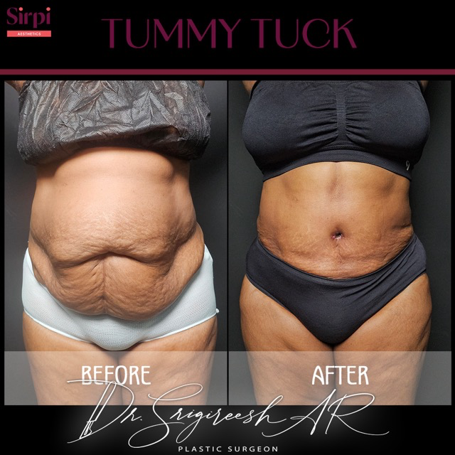 Tummy Tuck before and after